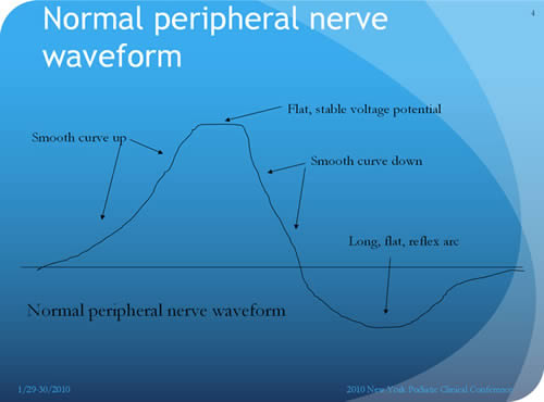 normal waveform